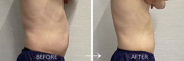 エアリアルのメンズ脂肪冷却痩身