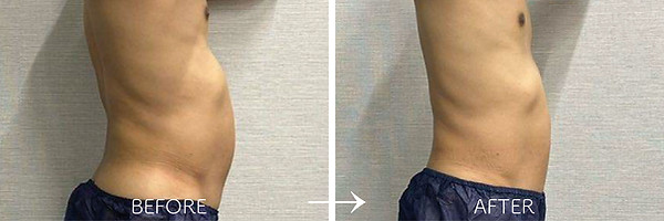 エアリアルのメンズ脂肪冷却痩身