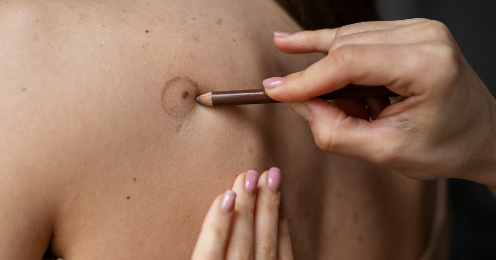 a patient getting a skin check for skin cancer