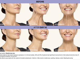 A before and after showing improvement in neck lines