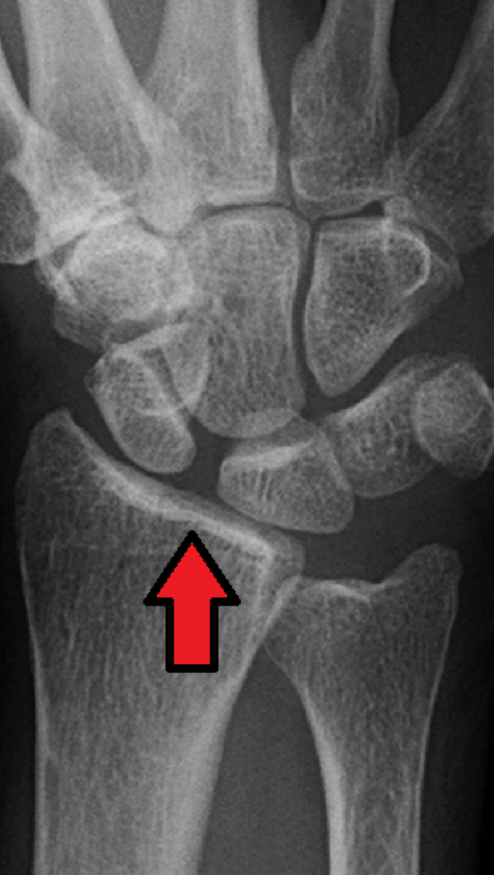 Capitate descending between scaphoid and lunate