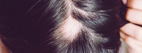 Closeup of person with bald spot