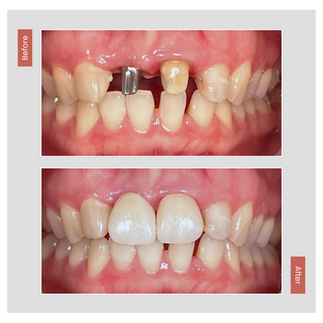 before after implan gigi
