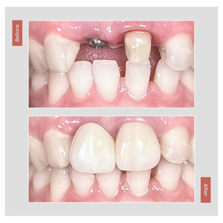 Before after pasang implan gigi