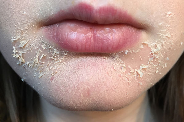 dry-and-flaky-skin-around-mouth.jpg