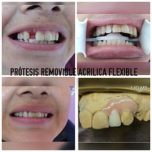 LATERAL VAL PLAS.jpg