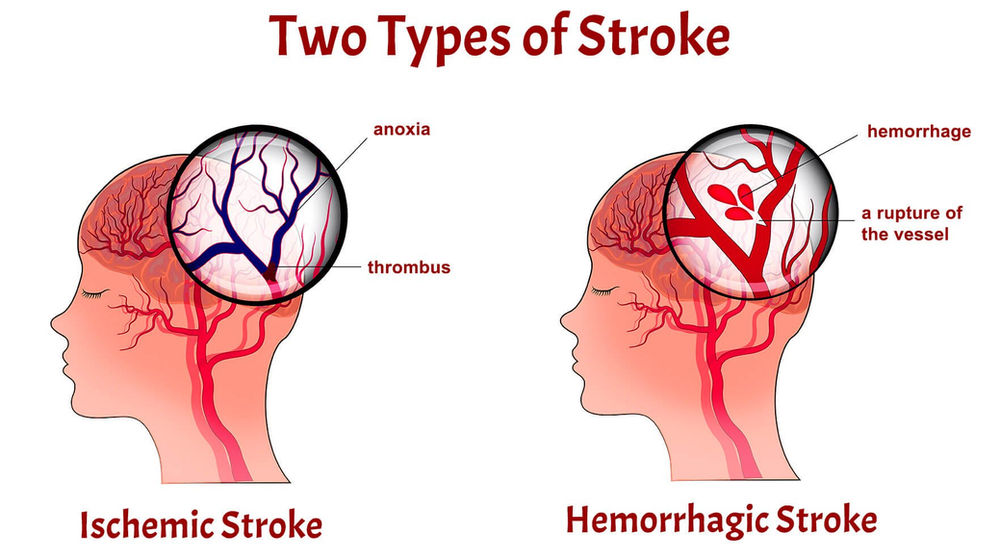 Stroke Rehabilitation