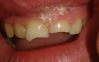 Emergency cosmetic dental bonding repair of broken teeth