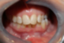 Invisalign teeth straightening
