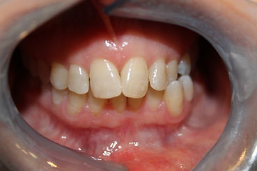 Invisalign teeth straightening