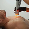 Laser Hair Removal