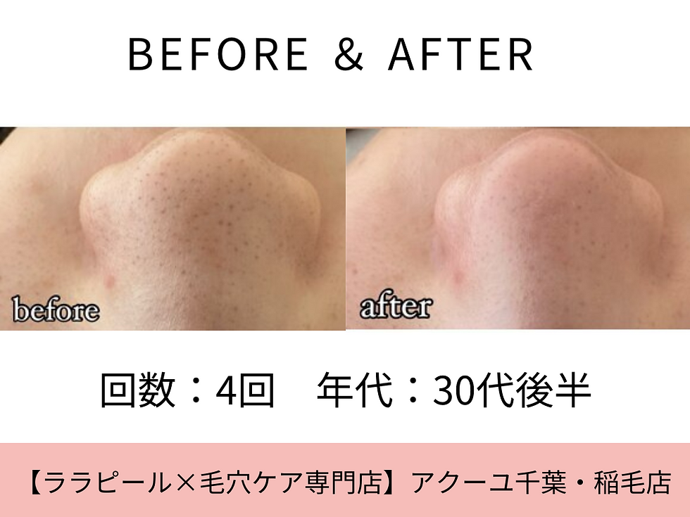 毛穴洗浄ビフォーアフター