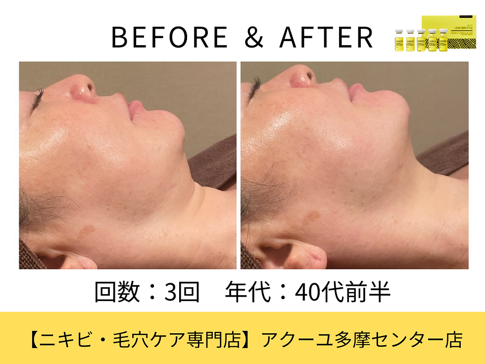 レモンビフォーア