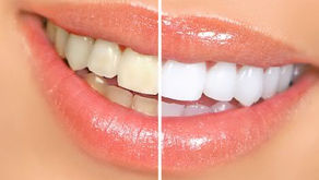 Tudo que você precisa saber sobre Clareamento Dental