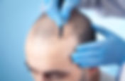 FUE Sapphire Hair Transplant