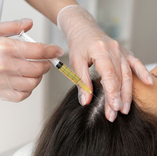 Stem Cell Therapy for Hair Transplantation