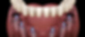 All-on-6 Dental Surgery