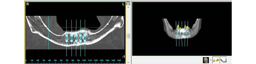 Teeth in One Day | Dr. Sergio Rubinstein