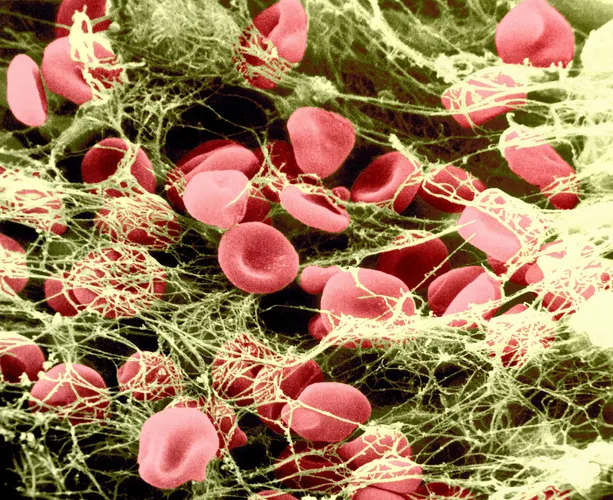 fibrin and red blood cells
