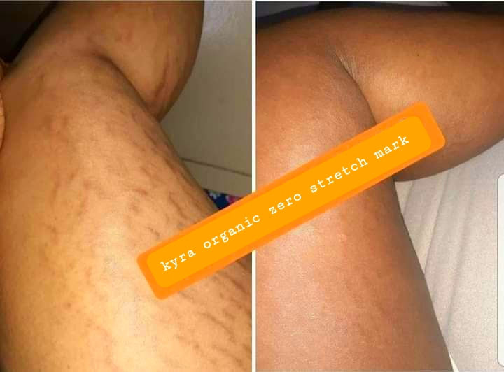 Thumbnail: 2L zero stretch mark 
