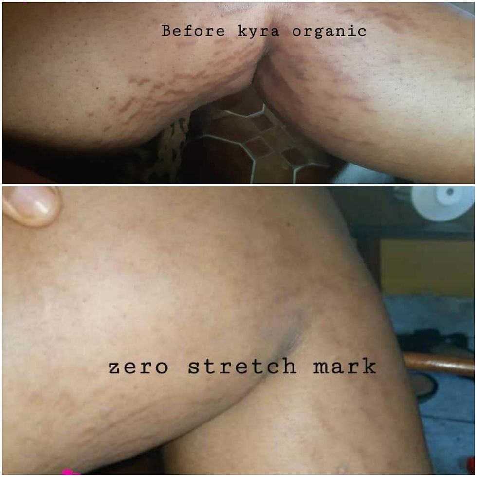 Thumbnail: 2L zero stretch mark 