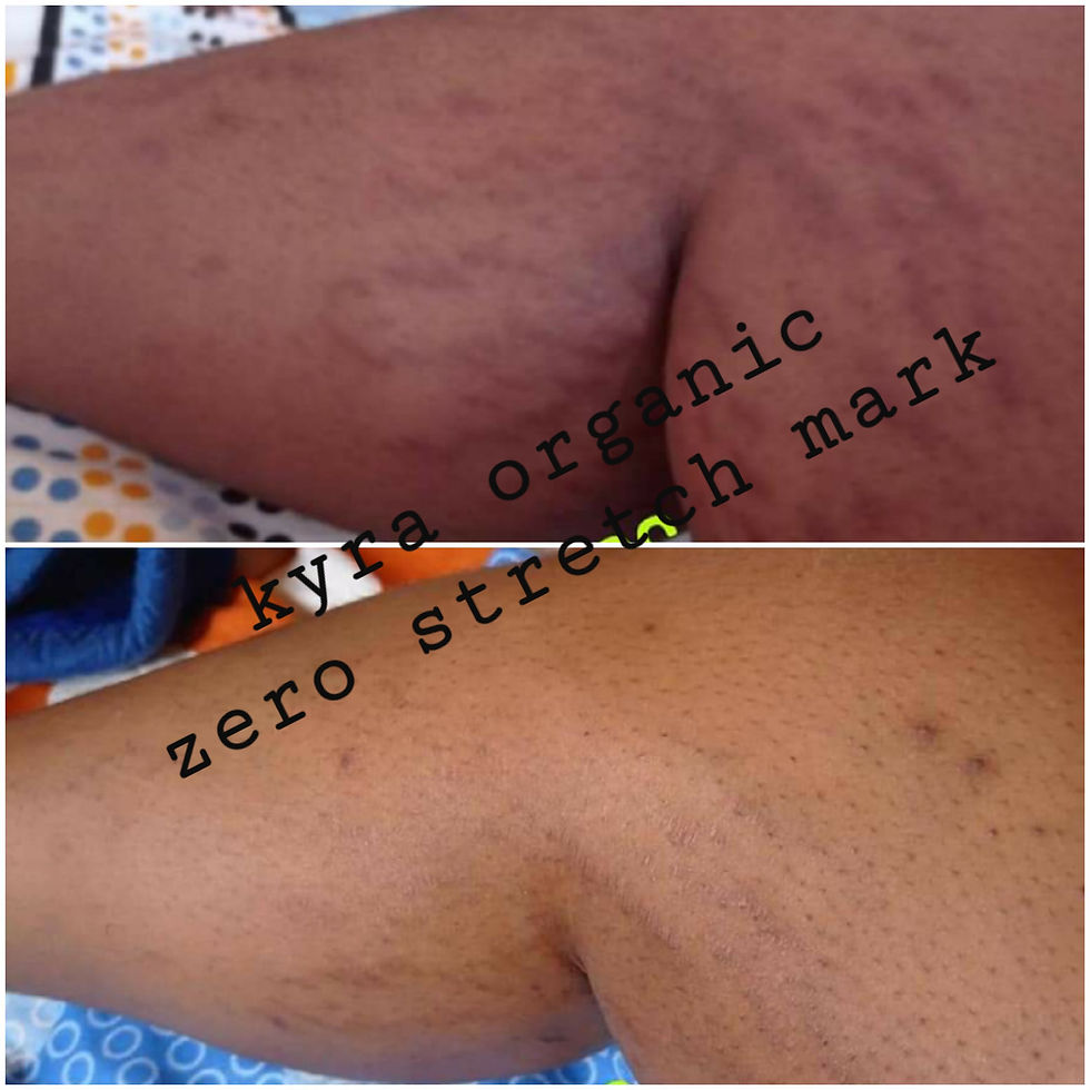 Thumbnail: 2L zero stretch mark 