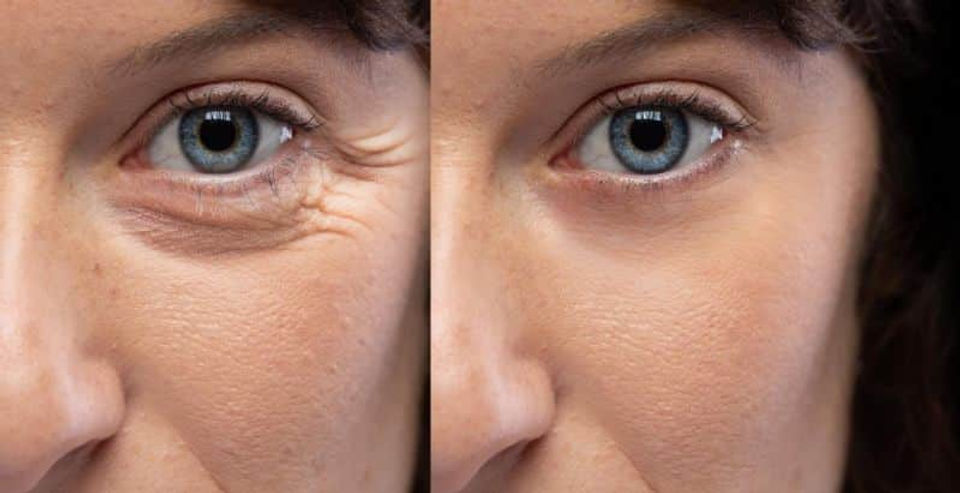 Blefaroplastia-sin-cirugia.jpg