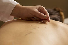 Acupuncture