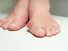 Rød og hoven kul ved stortåen – Hallux Valgus eller annen betennelse