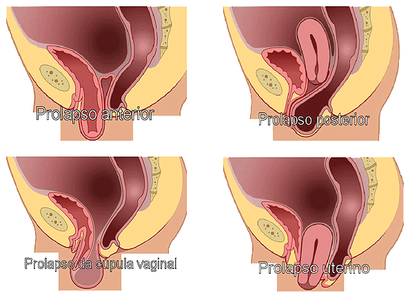 Prolapso genital