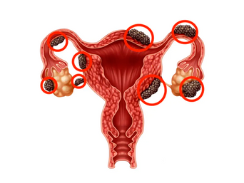 Cirugia para endometriose: Quando é indicada?