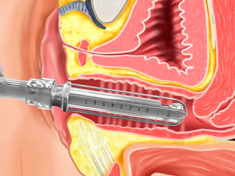 Como o laser vaginal pode tratar a atrofia vaginal pós-menopausa?