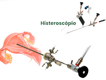 Histeroscopia: em que situações ela é indicada.