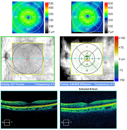 Why It’s Been More Than 18 Months Since Your Last Eye Exam — And Why That Matters