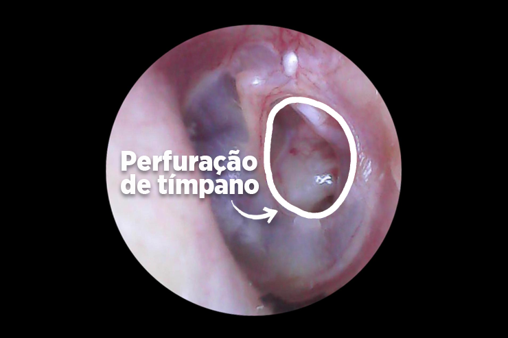 Perfuração do tímpano pode fechar sozinha?