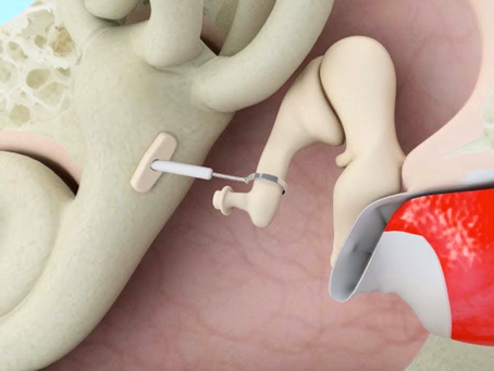 O que é Estapedotomia? Entenda a cirurgia indicada para Otosclerose
