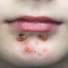 ImpetigoII.png