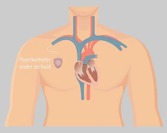 poortkatheter spoeling