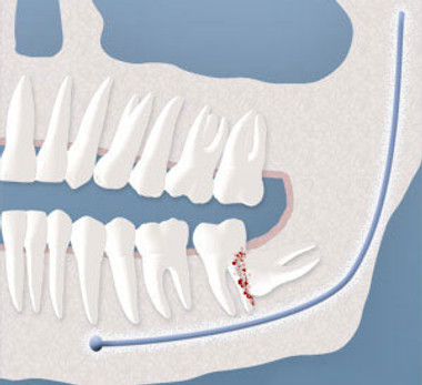 wisdom-tooth-damaging-other-tooth.jpeg