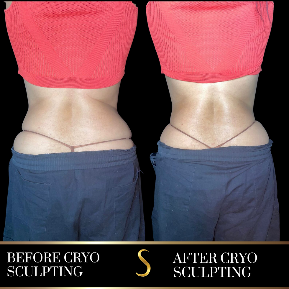Cryo Sculpting (Women)