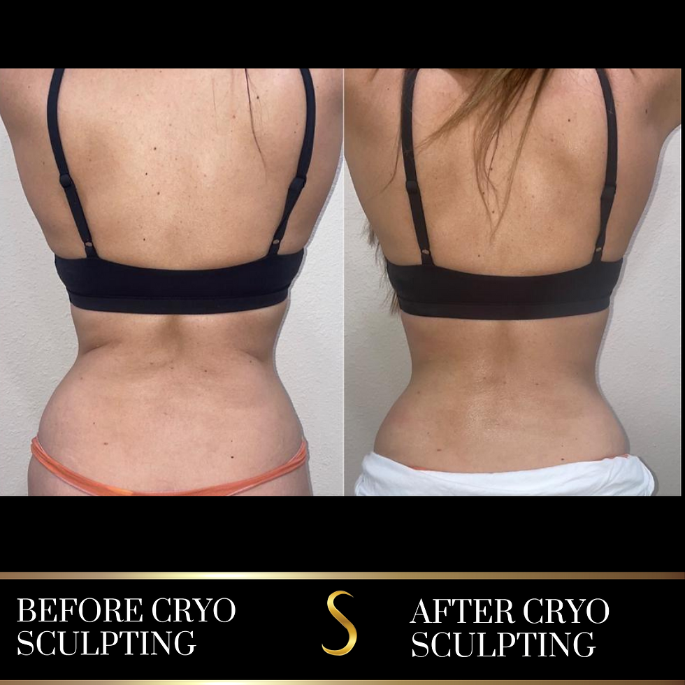 Cryo Sculpting (Women)