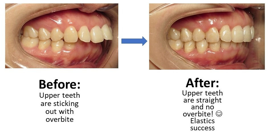 Fantastic elastics!!