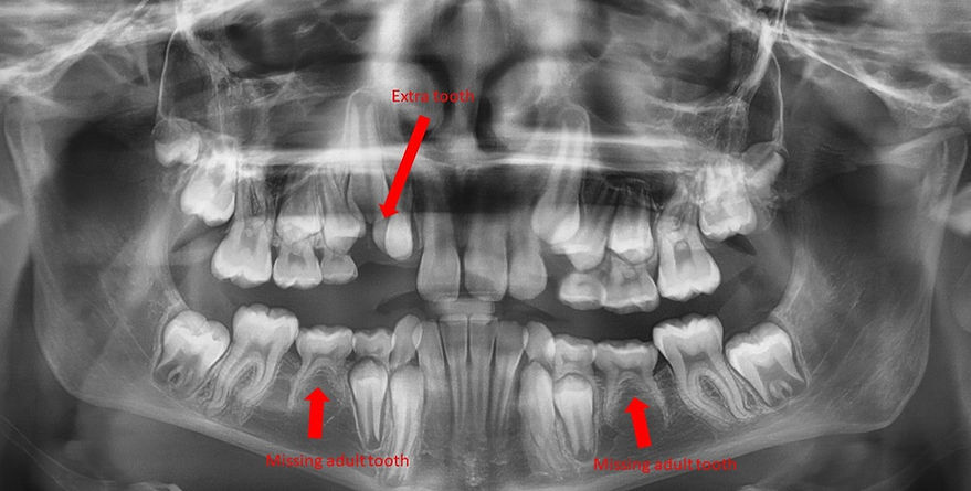 Missing Teeth Early VCO Orthodontics Arlington.jpg