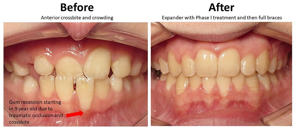 Crossbite VCO Orthodontics Arlington_edi