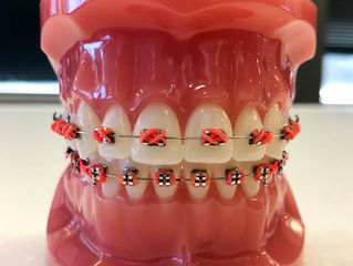 Trick or Treat: What candies are safe to eat with braces?