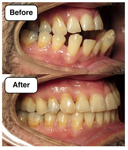 Surgical Orthodontics Arlington VA Before After JPG.jpg