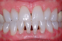 Why do I have black triangles or small spaces in between my teeth ...