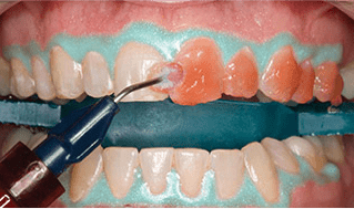Things you must know about whitening and tooth bleaching!