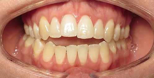 Before jaw surgery open bite VCO Orthodontincs