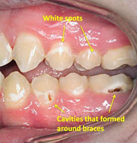 What are the risks of getting braces?